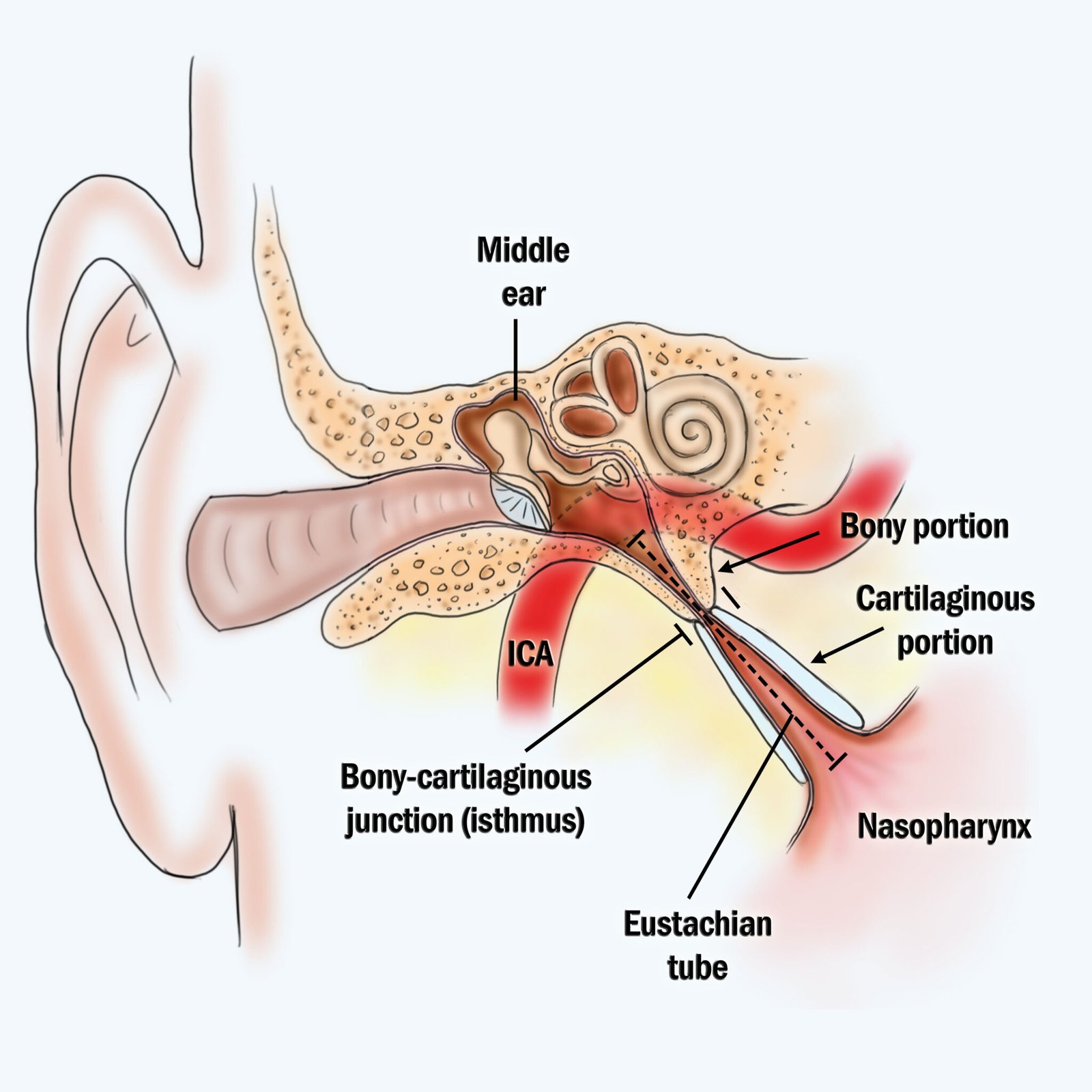 eustachian-tube-dysfunction-wax-removal-ni